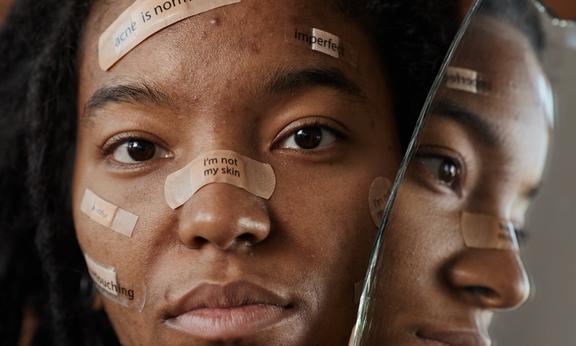 Acne inversa Beispielbild