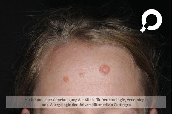 Tinea corporis