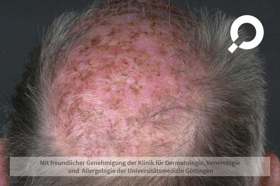 Aktinische Keratose