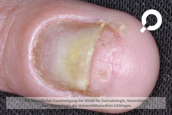 Nagelpsoriasis (Schuppenflechte der Nägel) 