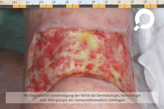 Ulcus cruris (offenes Bein)