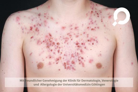 Akne (Acne vulgaris)  