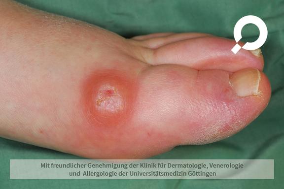 Raynaud-Syndrom