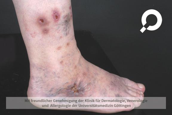 Chronisch venöse Insuffizienz