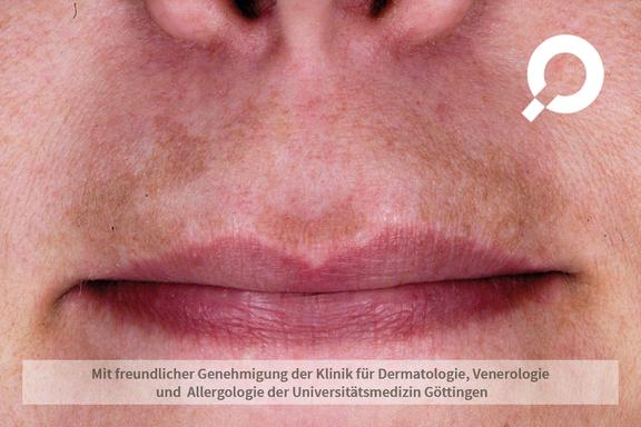 Melasma (Pigmentierungen)
