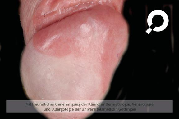 Balanitis (Eichelentzündung)