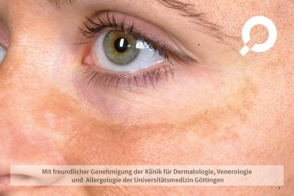 Melasma (Pigmentierungen)