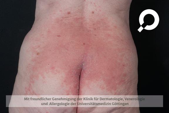 Psoriasis inversa