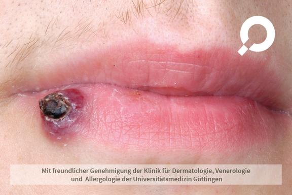 Granuloma pyogenicum (pyogenes Granulom) 