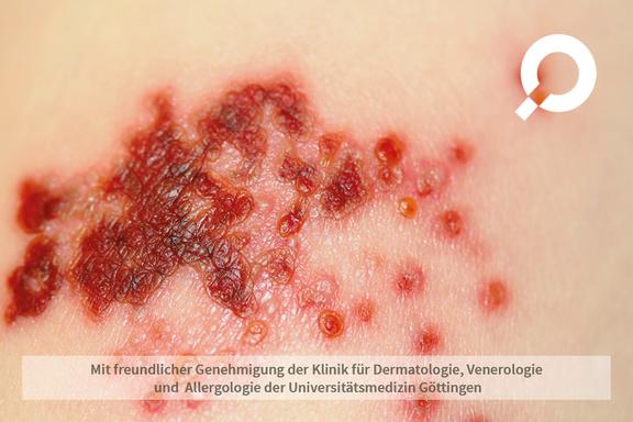Herpes Zoster (Gürtelrose)