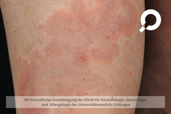 Borreliose