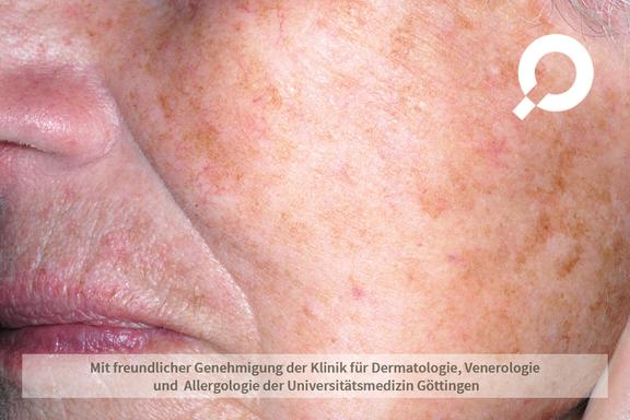 Lentigines solares (Altersflecken)