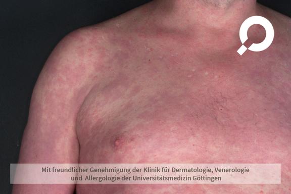 Psoriasis vulgaris (Schuppenflechte)