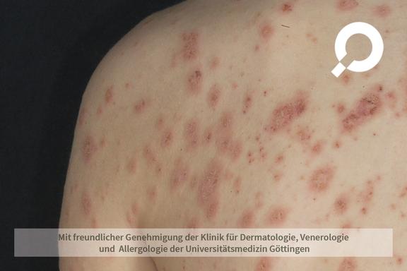 Pityriasis rosea (Röschenflechte)