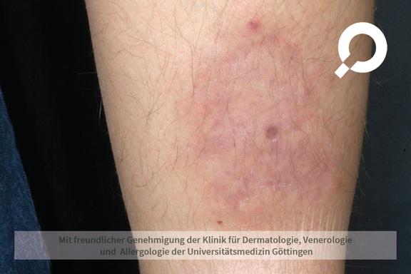 Erythema nodosum