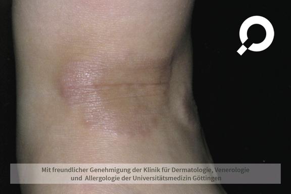 Granuloma anulare