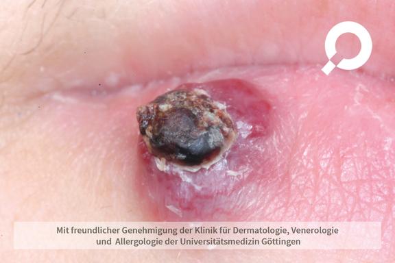 Granuloma pyogenicum (pyogenes Granulom) 