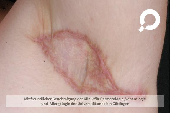 Hidradenitis suppurativa (Acne inversa)