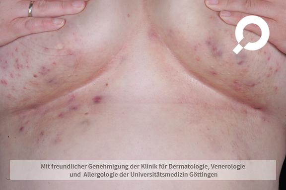 Hidradenitis suppurativa (Acne inversa)