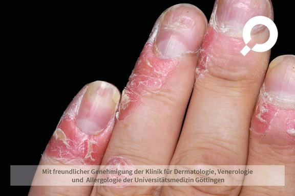Psoriasis vulgaris (Schuppenflechte)