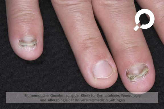 Onychomykose (Nagelpilz)