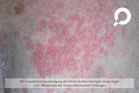 Pityriasis rosea (Röschenflechte)