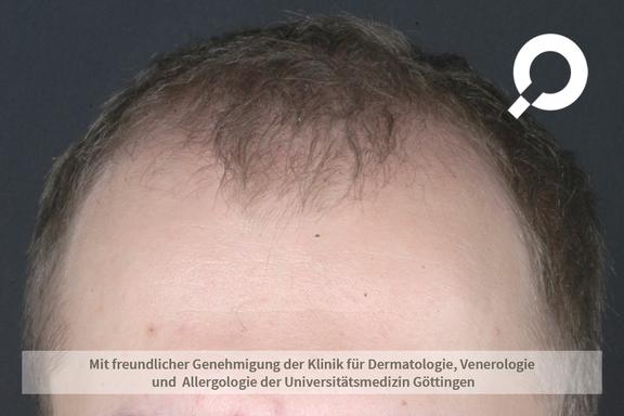 Androgenetische Alopezie (androgenetischer Haarausfall) 