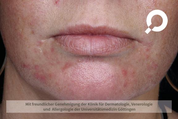Akne (Acne vulgaris)  
