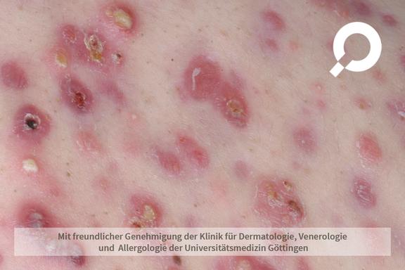 Akne (Acne vulgaris)  