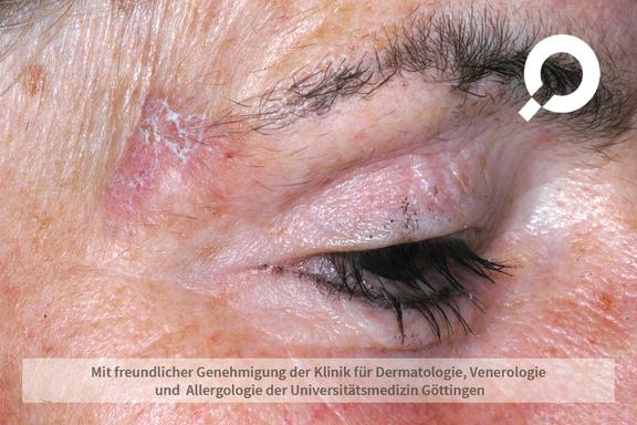 Aktinische Keratose