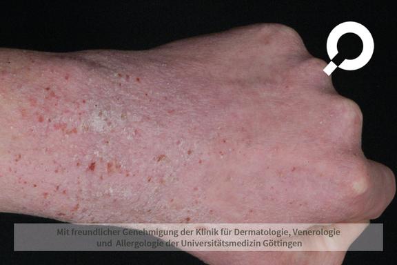 Atopische Dermatitis (Neurodermitis)