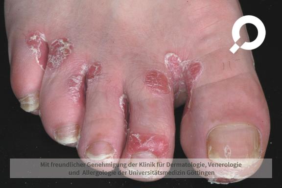 Psoriasis vulgaris (Schuppenflechte)