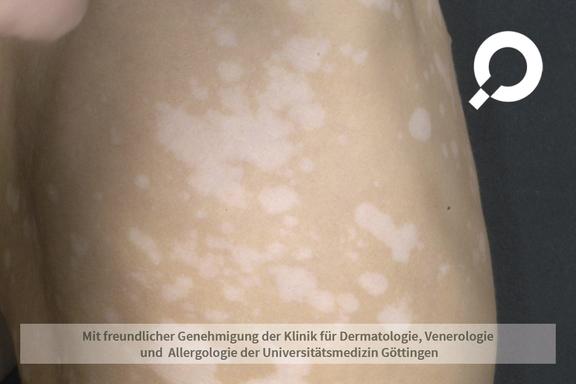 Vitiligo (Weißfleckenkrankheit) 