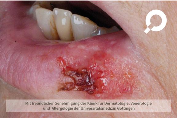 Herpes labialis (Lippenherpes)
