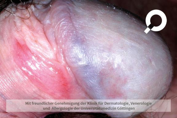 Balanitis (Eichelentzündung)