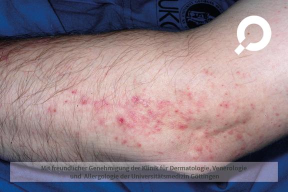 Allergisches Kontaktekzem (allergische Kontaktdermatitis)