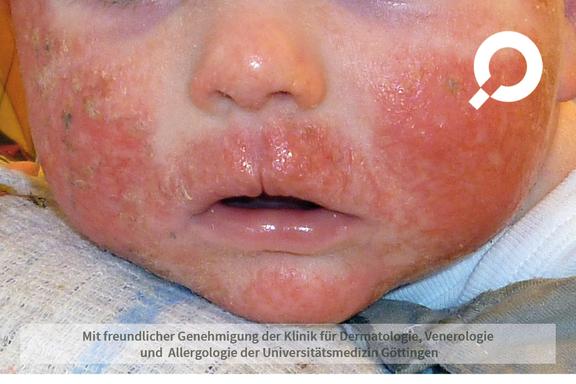 Atopische Dermatitis (Neurodermitis)