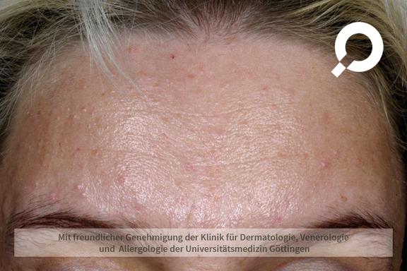 Akne (Acne vulgaris)  