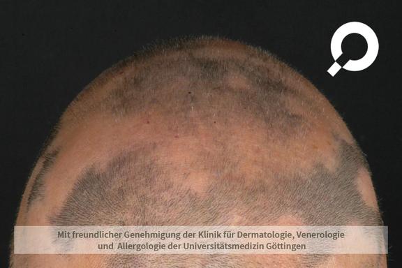 Alopecia areata (kreisrunder Haarausfall) 