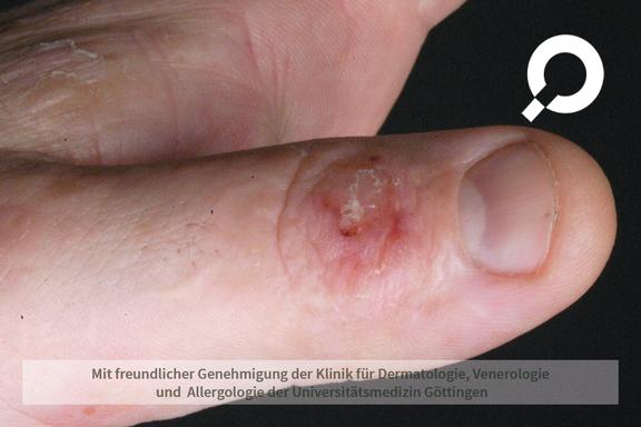 Allergisches Kontaktekzem (allergische Kontaktdermatitis)