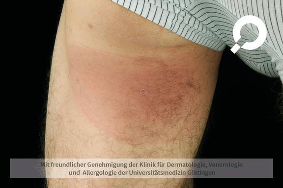 Borreliose
