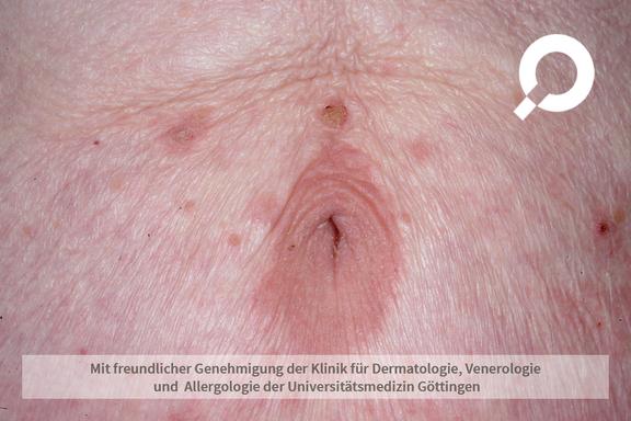 Psoriasis inversa