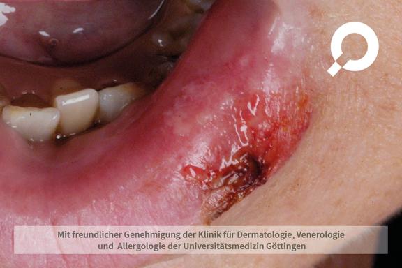 Herpes labialis (Lippenherpes)