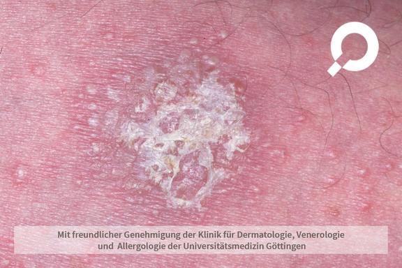Psoriasis vulgaris (Schuppenflechte)