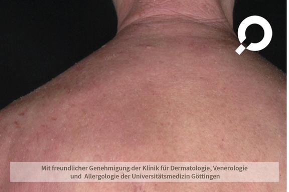 Atopische Dermatitis (Neurodermitis)