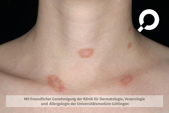 Tinea corporis