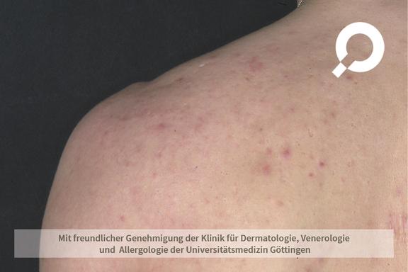 Akne (Acne vulgaris)  