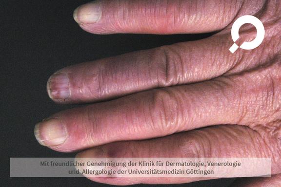 Raynaud-Syndrom
