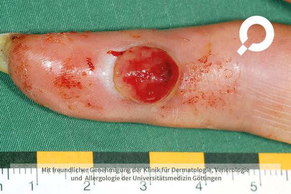 Granuloma pyogenicum (pyogenes Granulom) 