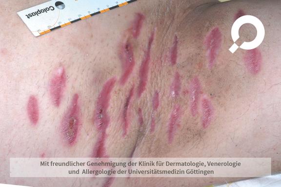 Hidradenitis suppurativa (Acne inversa)